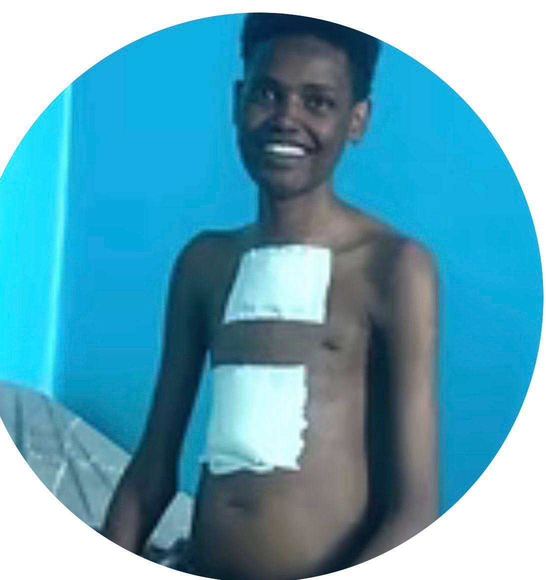 OMAR – HVE 14th patient.