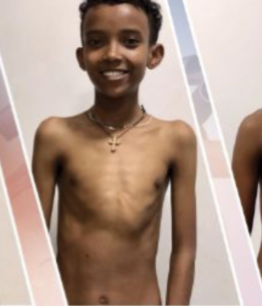 YORDANOS – HVE 10th patient